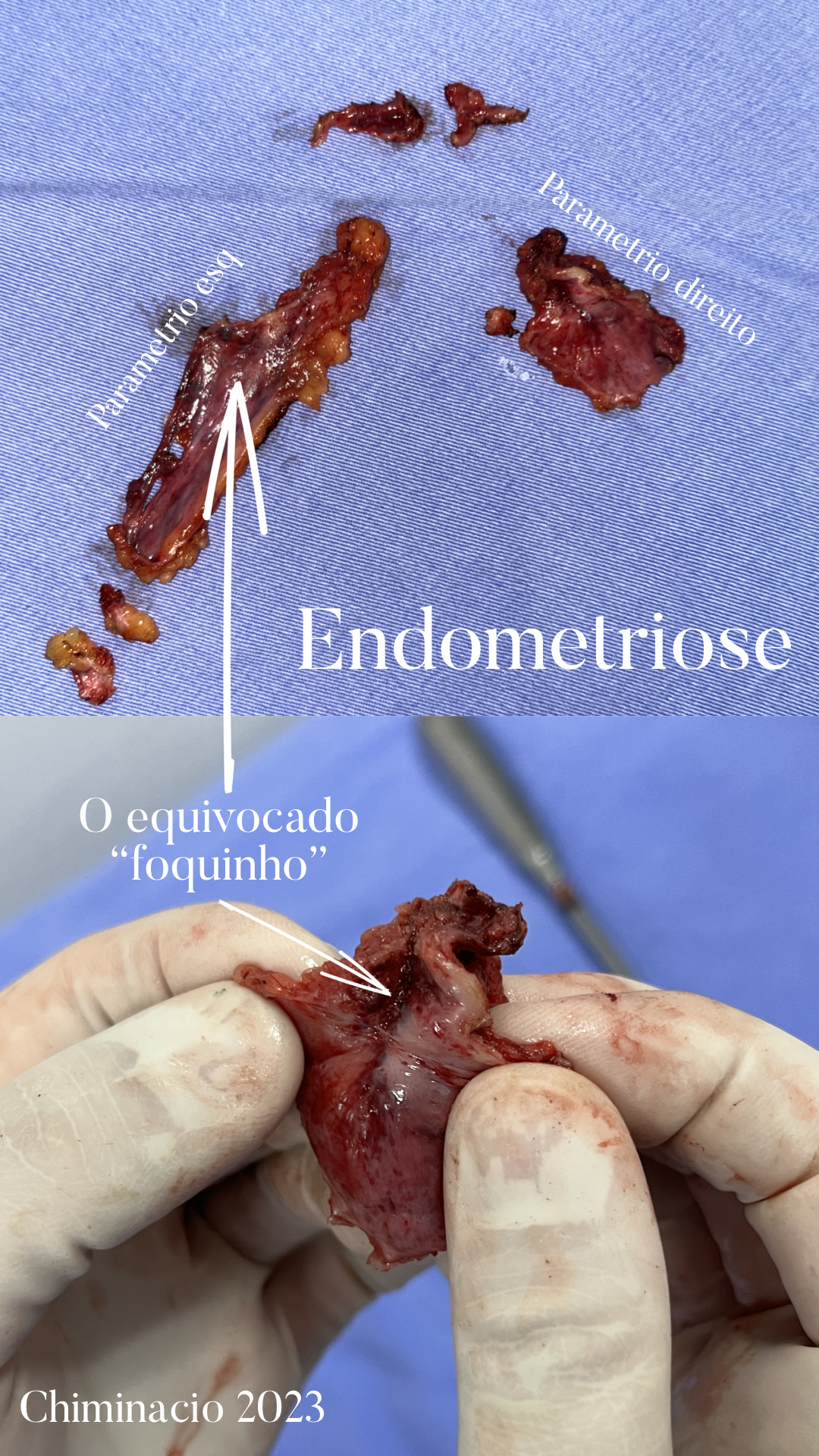 Endometriose e menstruação